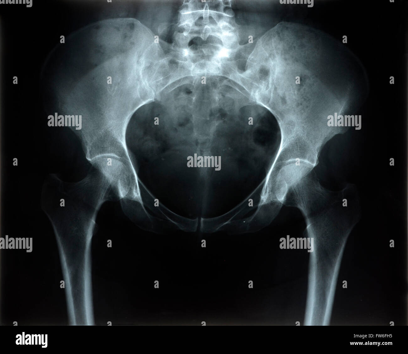 Radiografía de la pelvis Foto de stock