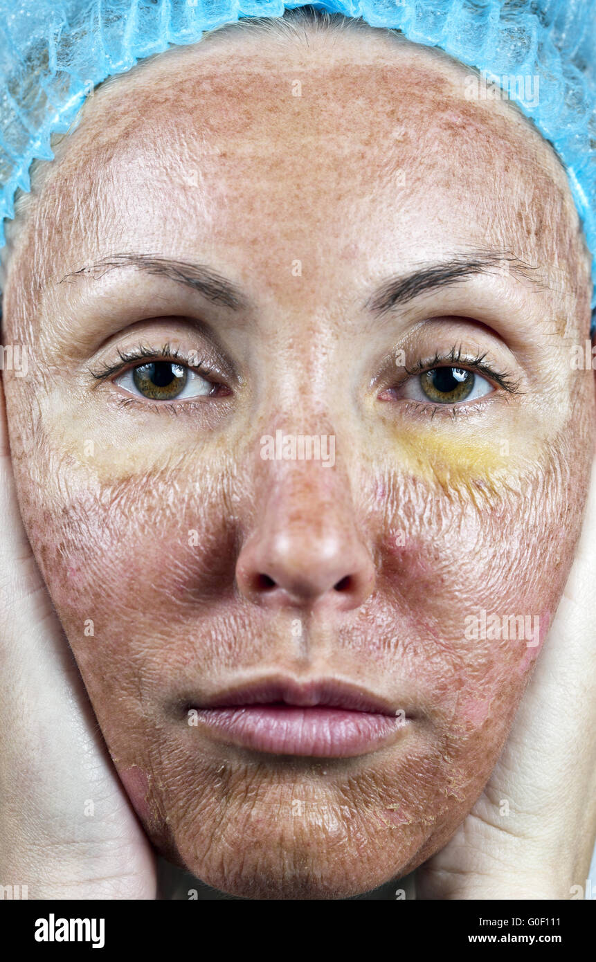 Cosmetología. la piel después de un peeling químico Fotografía de stock Alamy