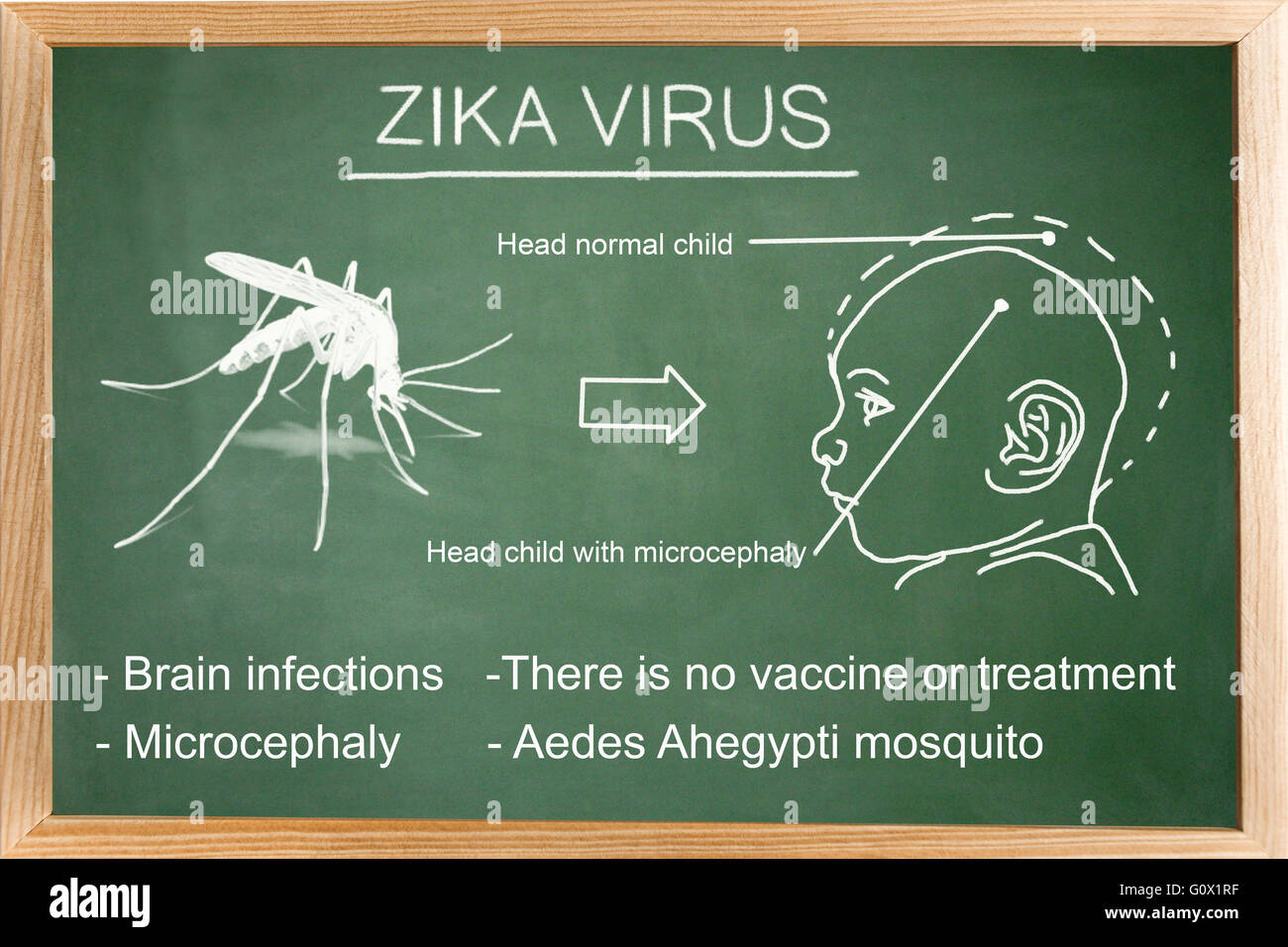 Diagrama conceptual dibujado con tiza sobre una pizarra verde de la Zica de virus (ZIKV), los síntomas y el desarrollo de virus Zika Foto de stock