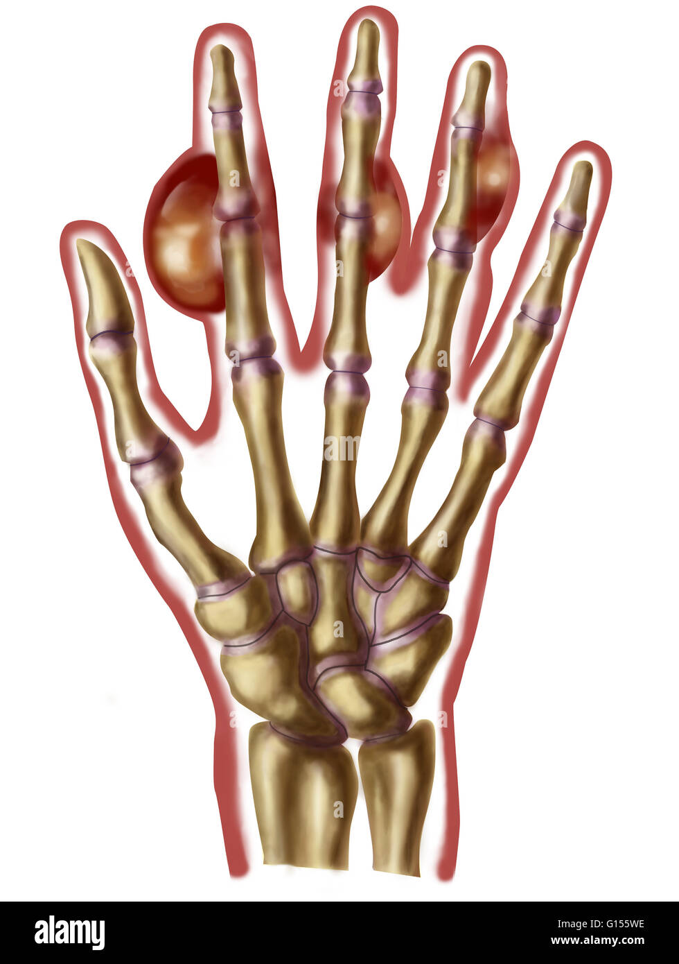 Ilustración de una mano humana con los tofos o hinchazón en las  articulaciones de los dedos, debido a la gota. La gota es causada por  niveles elevados de ácido úrico en la