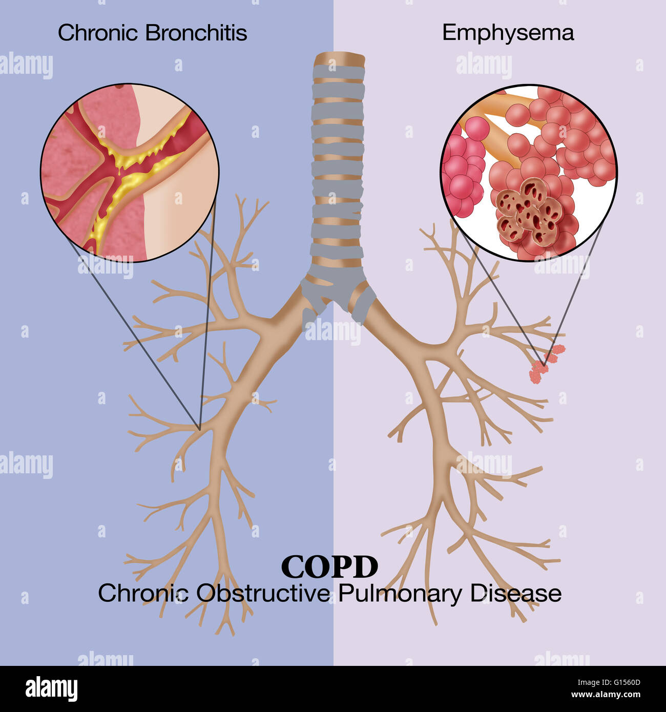 Ilustración de la enfermedad pulmonar obstructiva crónica (EPOC), una