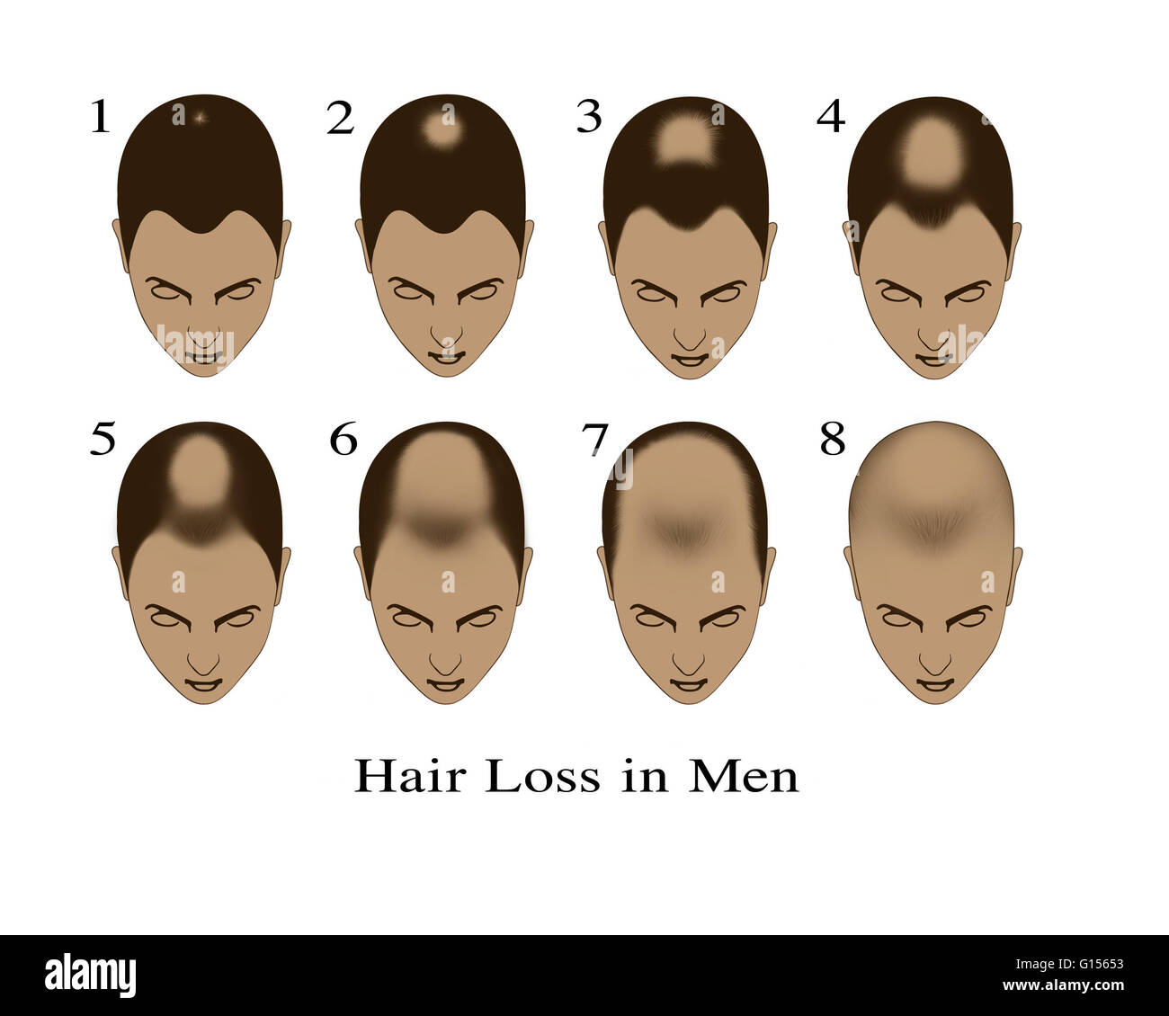 Ilustración que muestra las fases de pérdida de cabello en los hombres