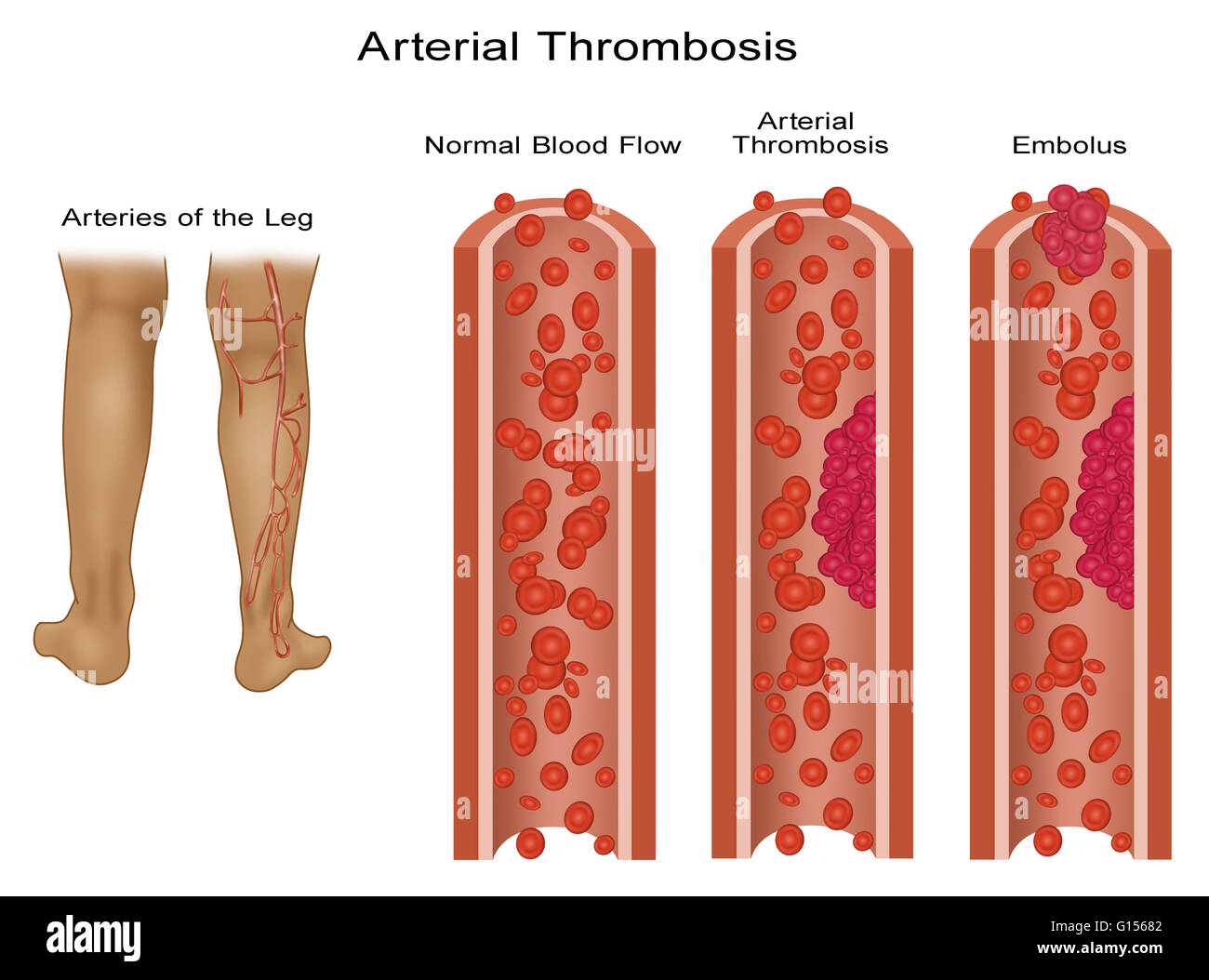 Trombosis Arterial Fotografías E Imágenes De Alta Resolución Alamy