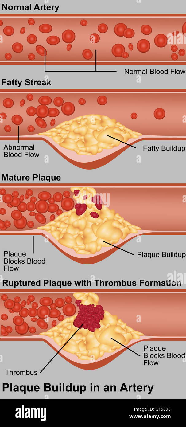 Atheroma plaque formation fotografías e imágenes de alta resolución Alamy