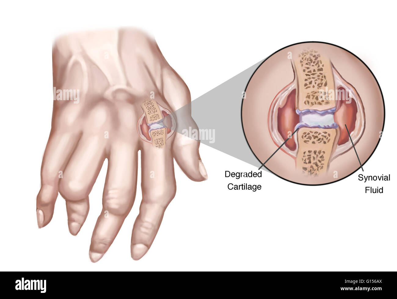 Una ilustración que muestra la degradación del cartílago y el fluido sinovial de la articulación de una persona con artritis reumatoide. Foto de stock