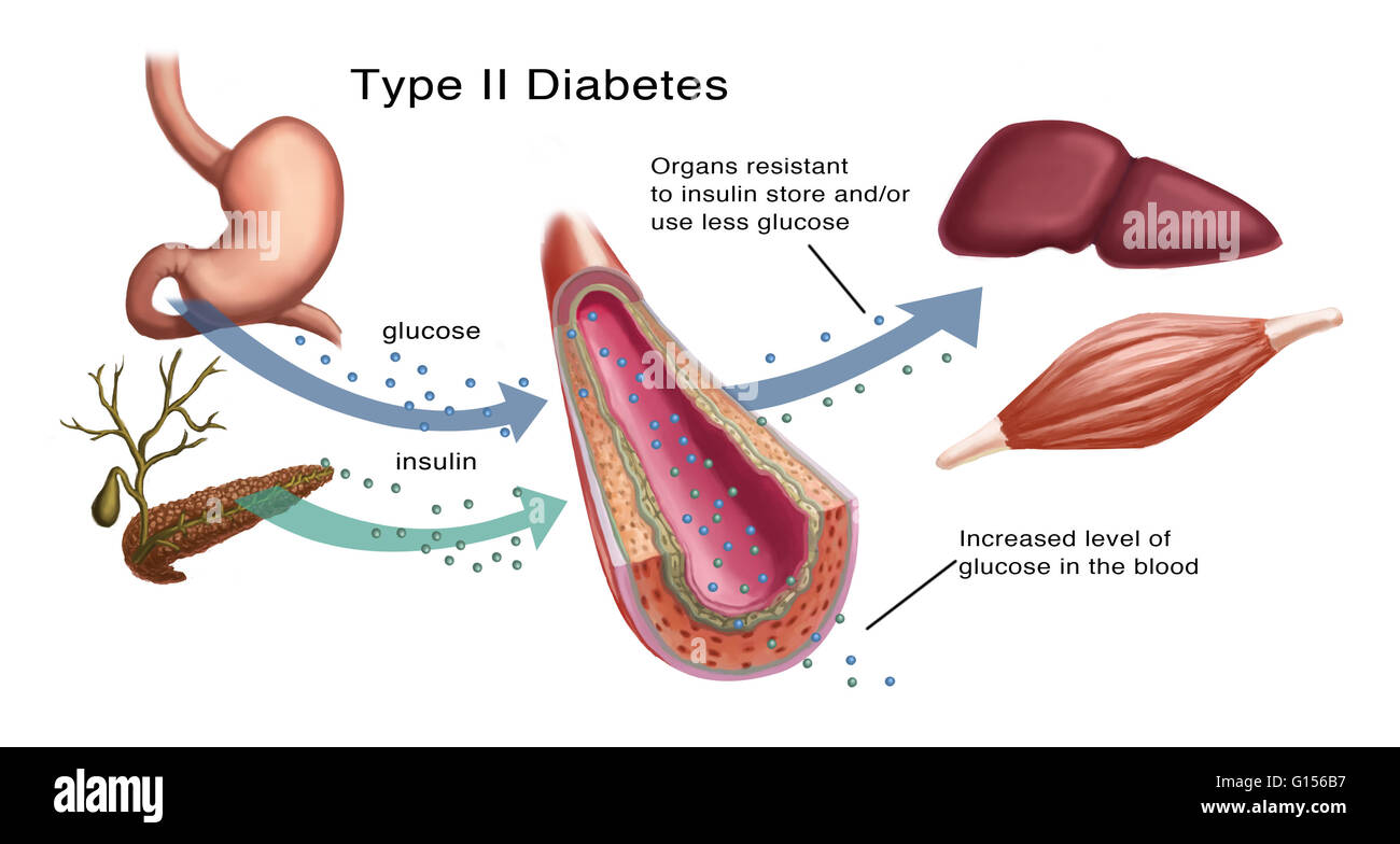 Rebaja Fugaz Petición Ilustración de la producción de insulina y glucosa en la diabetes tipo 2.  La insulina es producida por las células de los islotes del páncreas, y  actúa al unísono con la glucosa