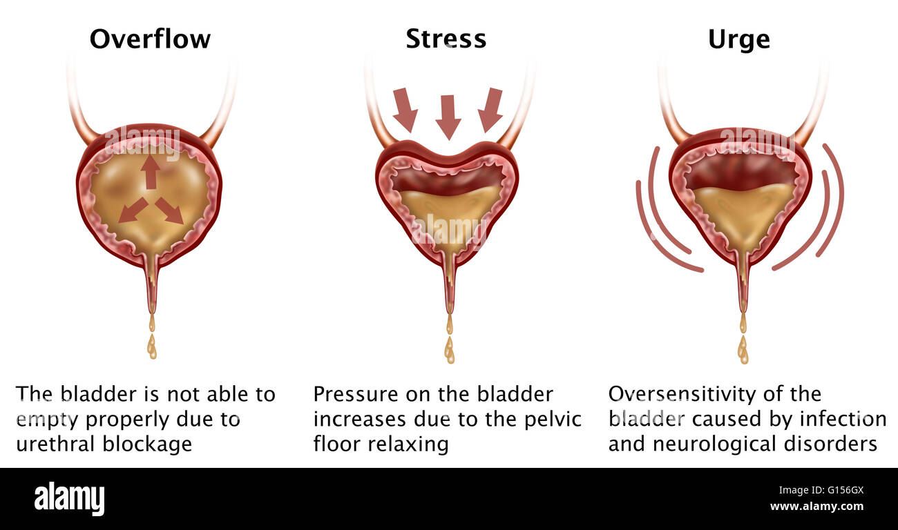 Ilustración que muestra tres tipos de incontinencia: desbordamiento, estrés  y ganas. Incontinencia por rebosamiento: ocurre en personas que tienen una  obstrucción de la salida de la vejiga (en esta ilustración, el  estrechamiento