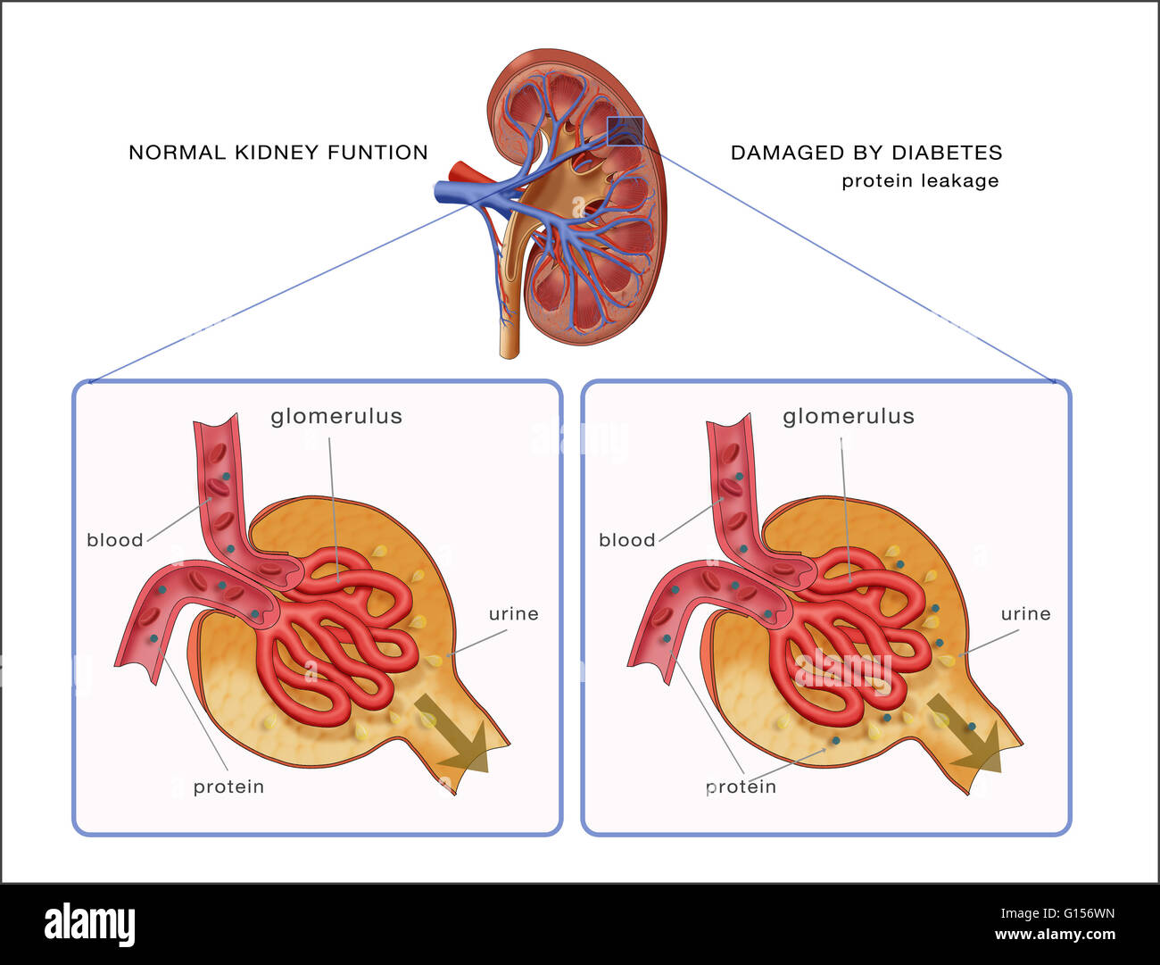 Ilustración De Una Comparación En Paralelo De La Función Renal Normal Y Un Riñón Dañado Por La 7157