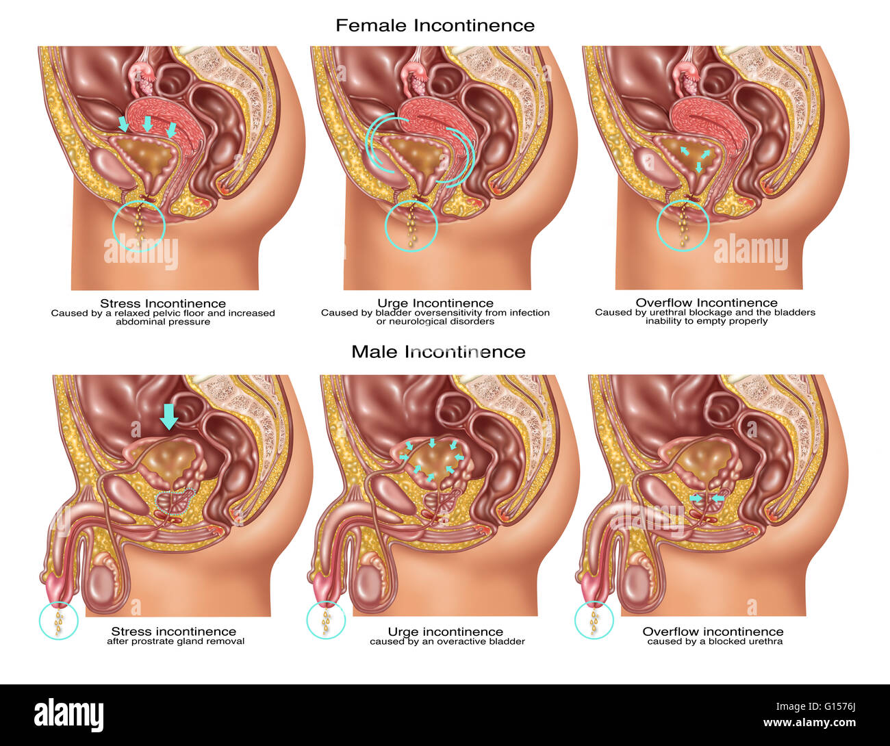Ilustración que muestra tres tipos de incontinencia: (de izquierda a  derecha) el estrés, instar, e incontinencia por rebosamiento. Los tres  tipos son ilustrados en la anatomía femenina (en la parte superior) y