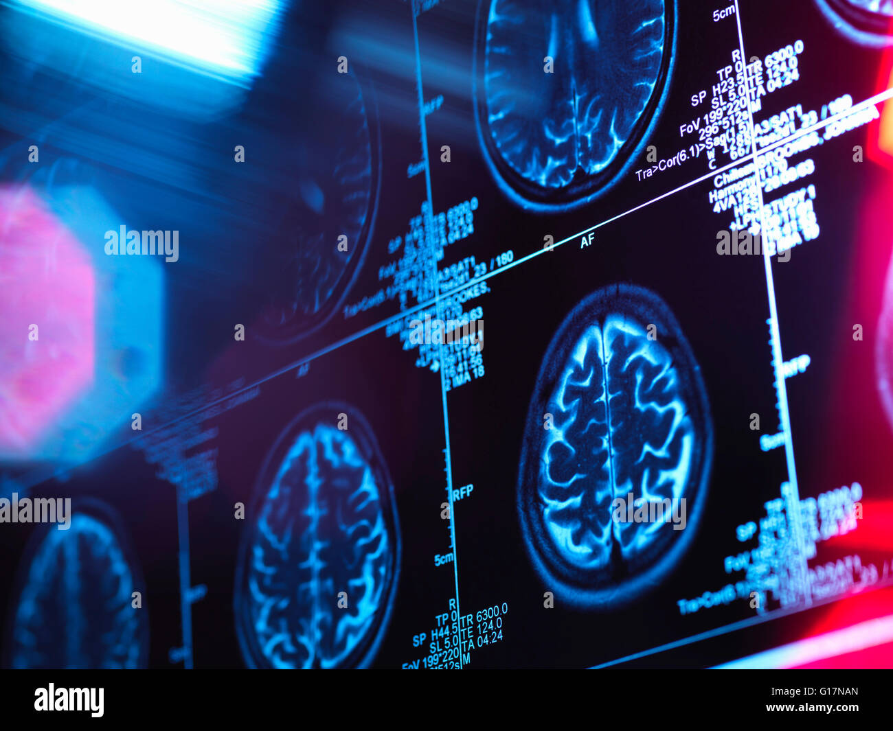 Escanear en un cerebro humano neurología clínica Foto de stock