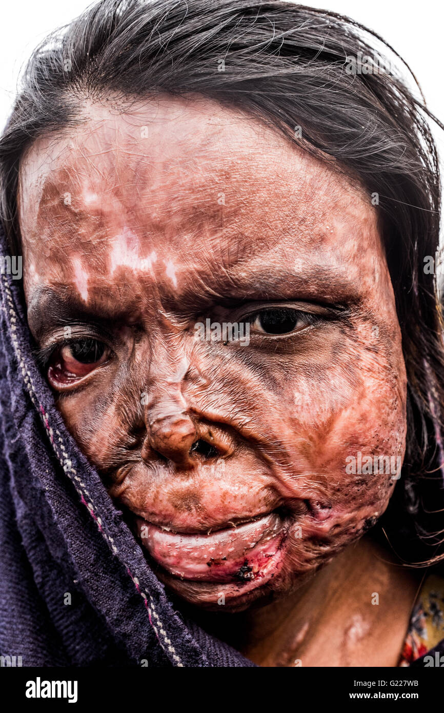 Mujer con la cara quemada, Delhi, India Fotografía de stock - Alamy