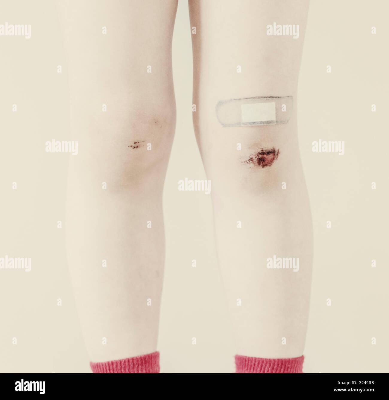 Las piernas del niño con contusiones y BAND-AID Foto de stock