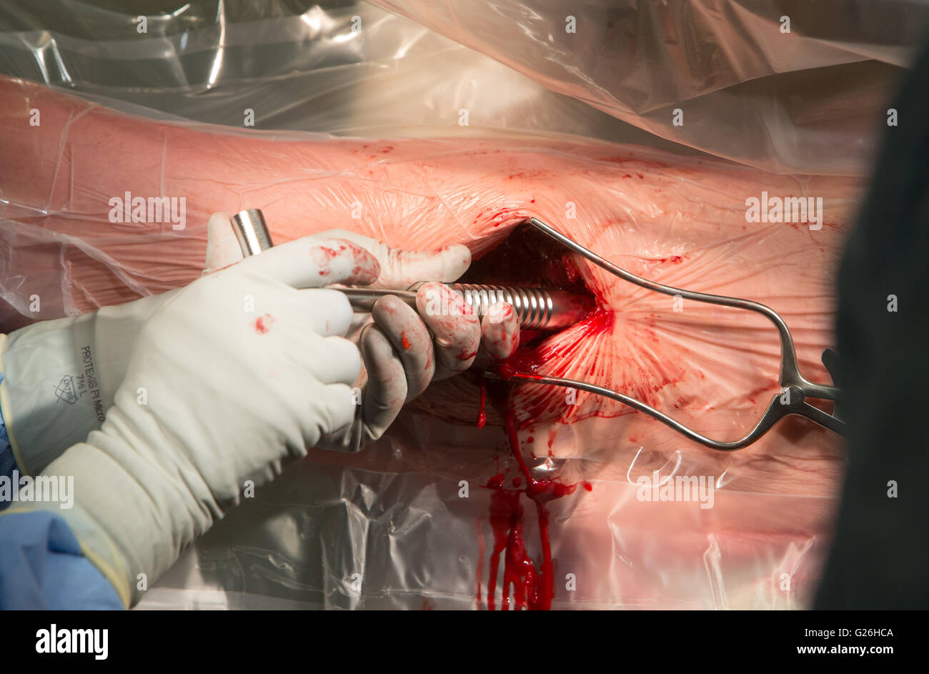 Cirujano en el teatro trabajando en un tornillo de cadera izquierda descompresión operación.uo de cerrar la operación. Foto de stock