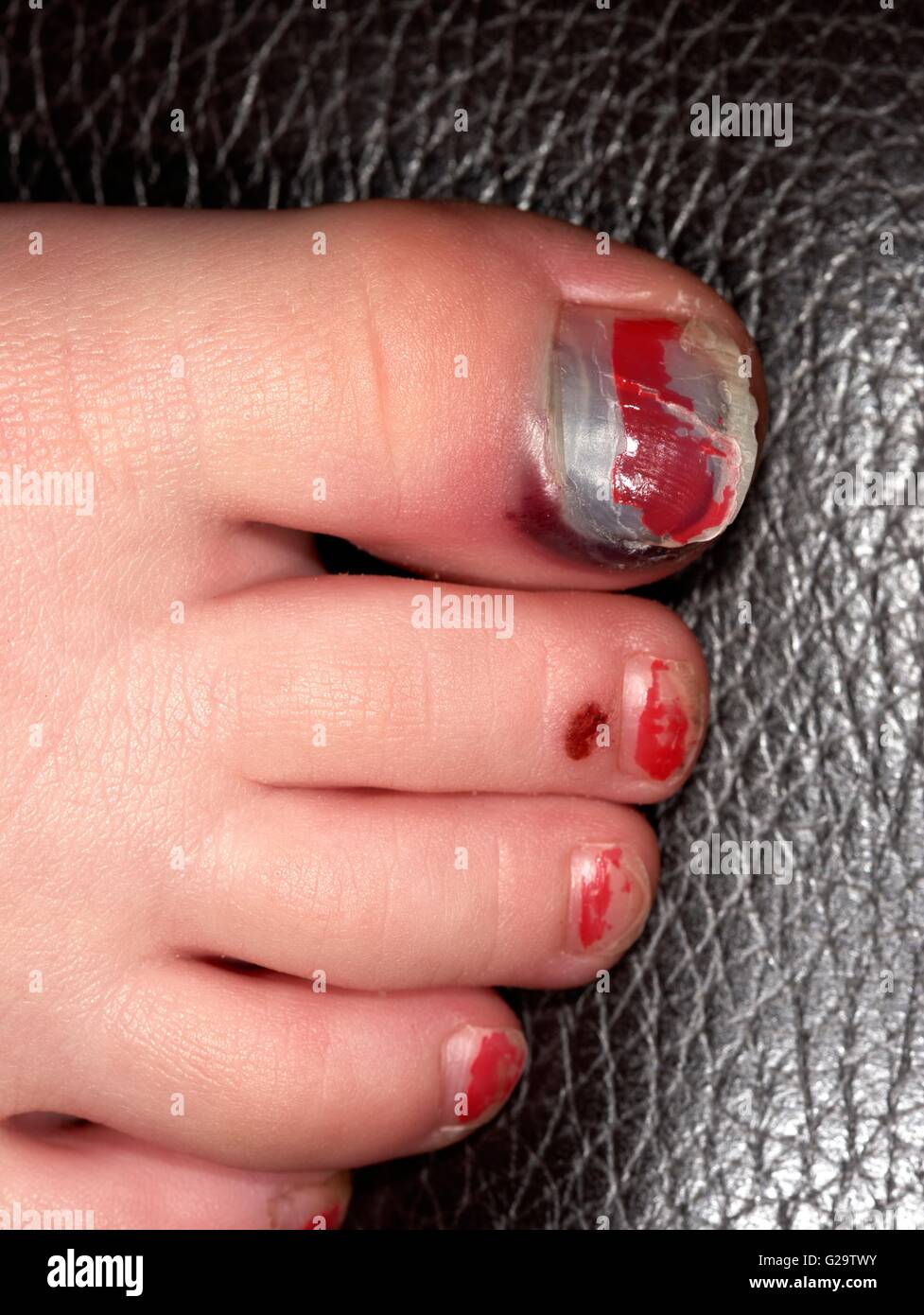 Lesión en el dedo gordo del pie fotografías e imágenes de alta resolución -  Alamy