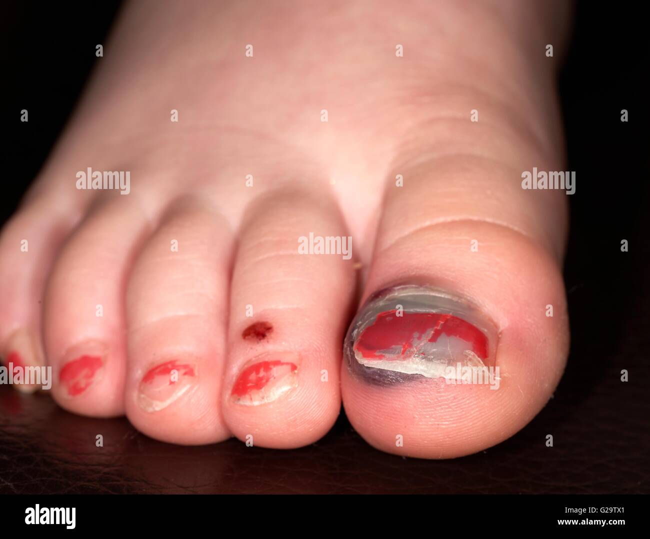 Una niña de tres años el pie con una ampolla de sangre bajo su dedo gordo  Fotografía de stock - Alamy