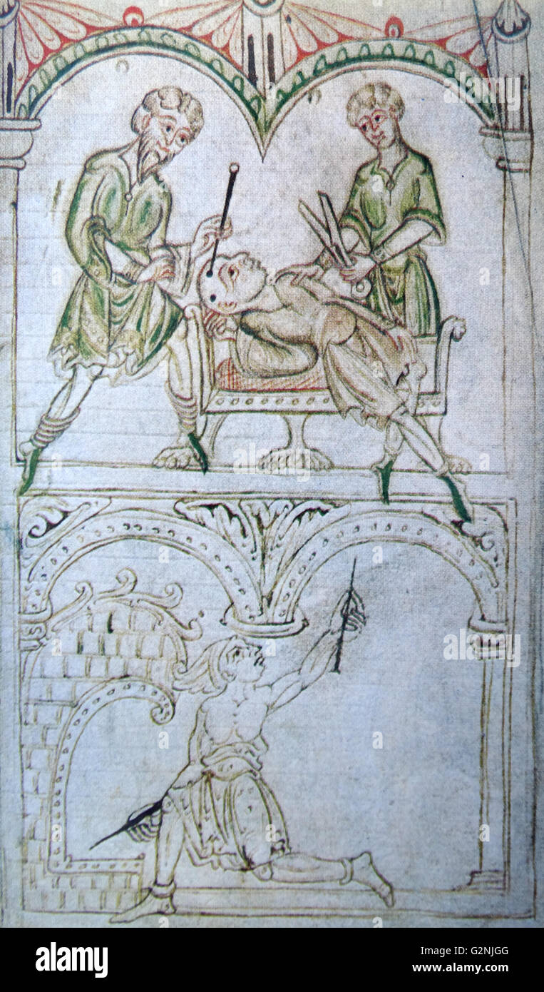 Dibujo medieval, demostrando la cauterización de los templos; en la parte inferior del dibujo muestra la calefacción auxiliar de los instrumentos. Fecha del siglo XII. Foto de stock