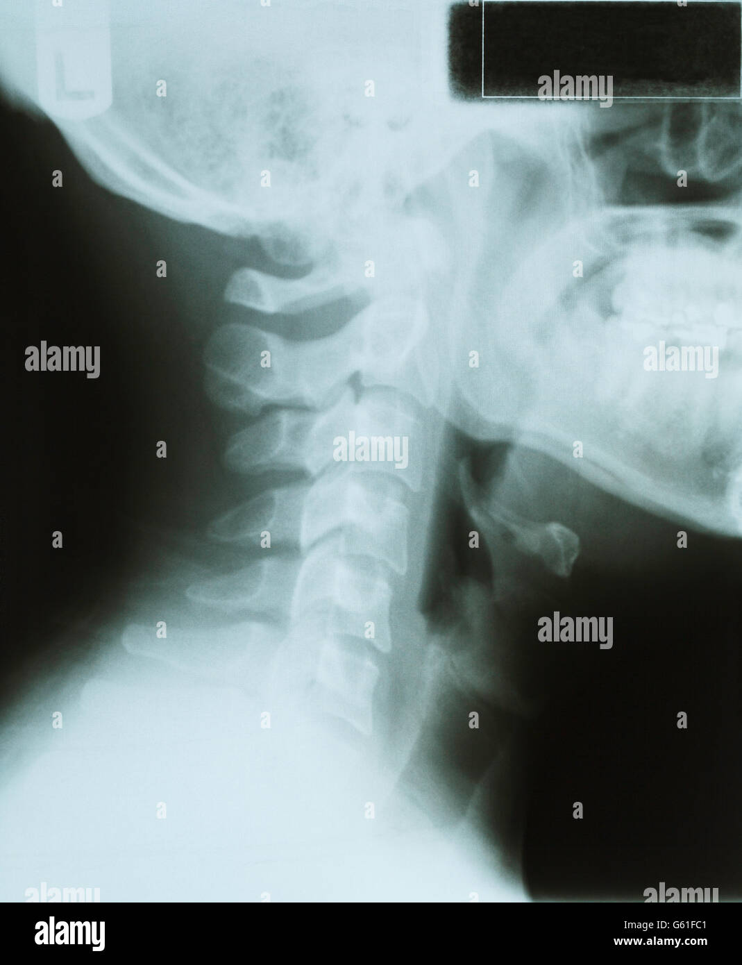 Vista lateral de los rayos X del cuello y la cabeza. Foto de stock