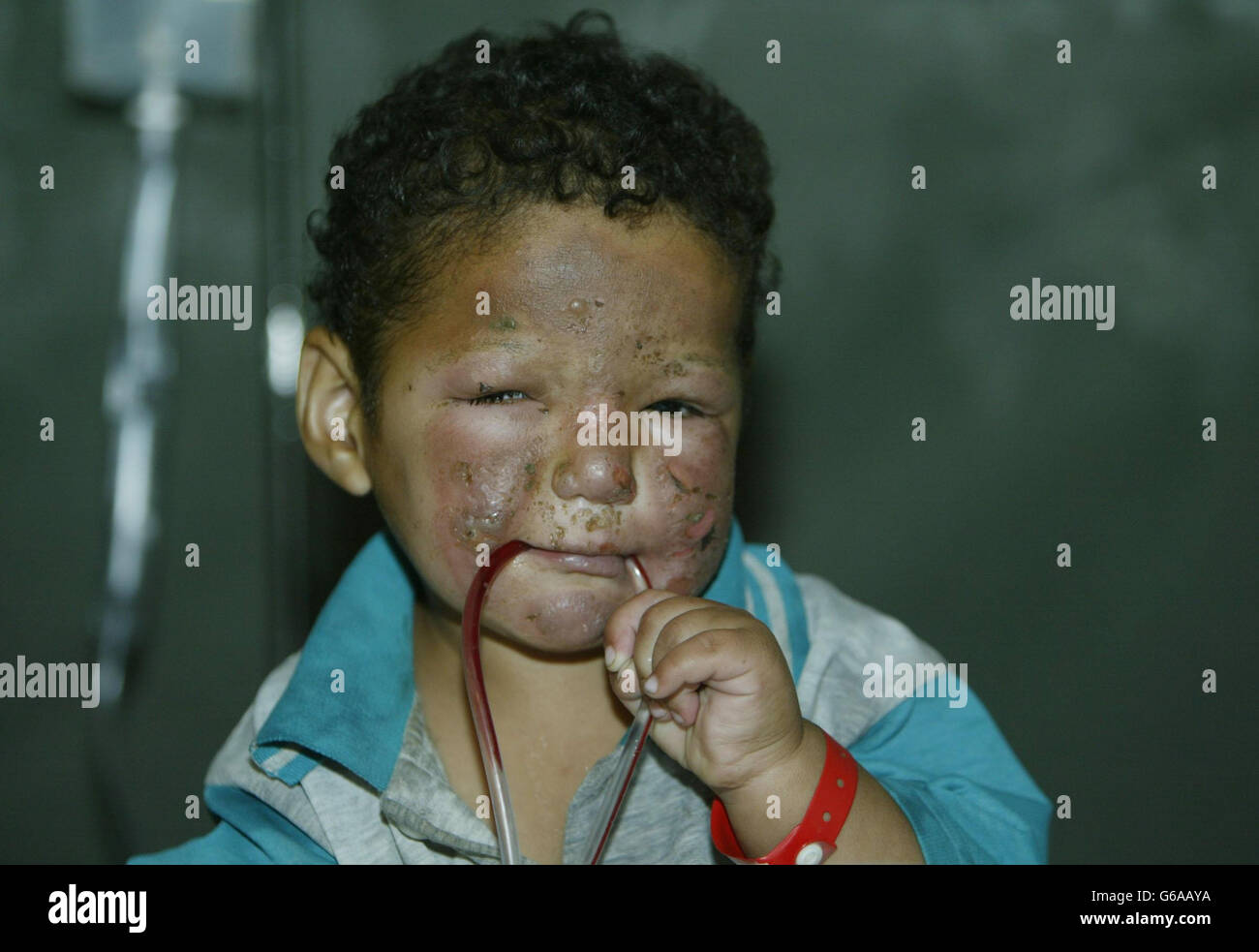 Un niño iraquí herido, Abbas, de 2 años, en un hostial de campo cerca de Basra, Irak. Pa Photo/Guardian/Dan Chung/mod POOL. Foto de stock
