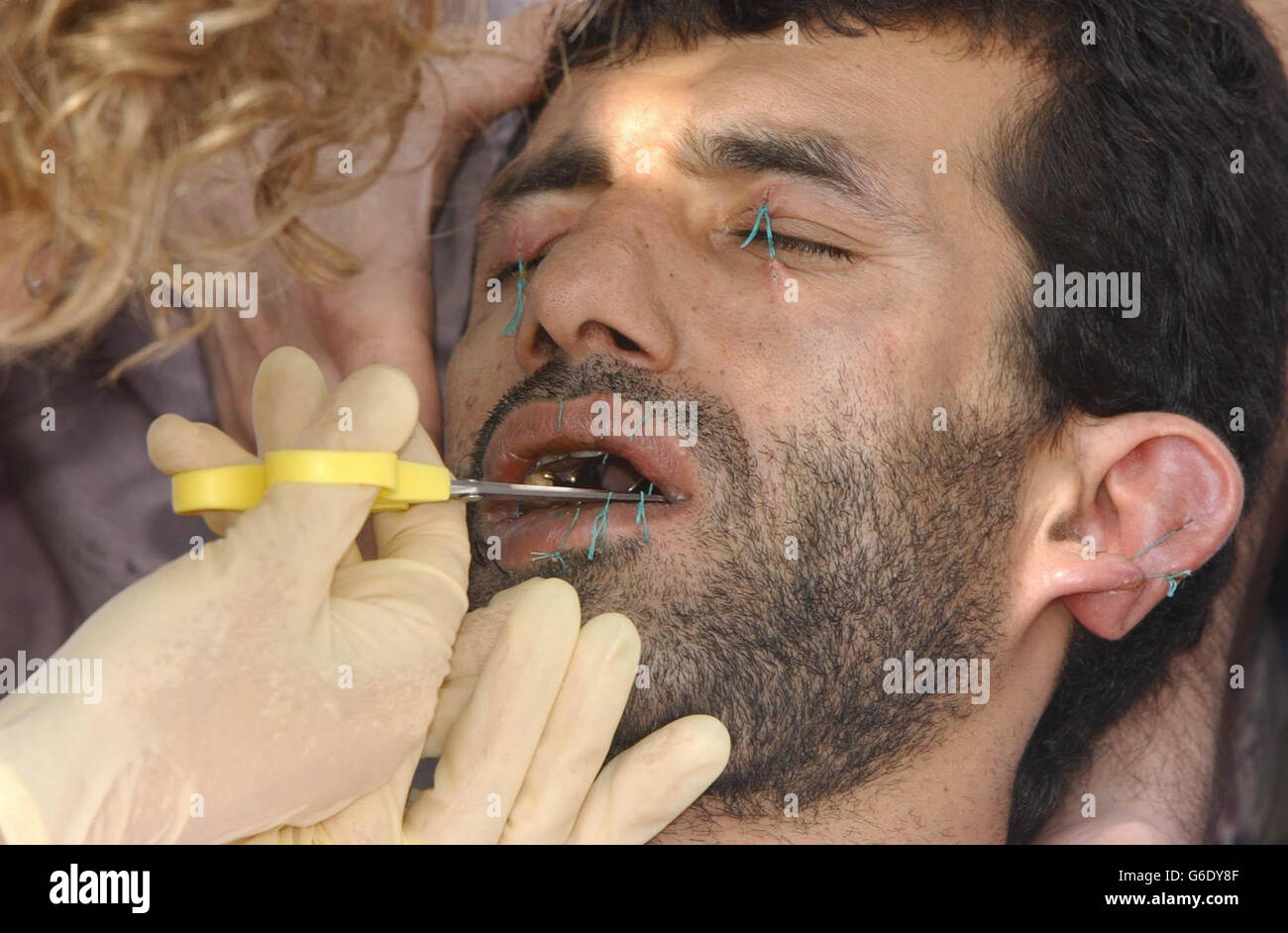 Un enfermero, cerca de su alojamiento alquilado, en Sneinton, Nottingham, cortó los puntos de los labios del refugiado iraní Abbas Amini. Foto de stock