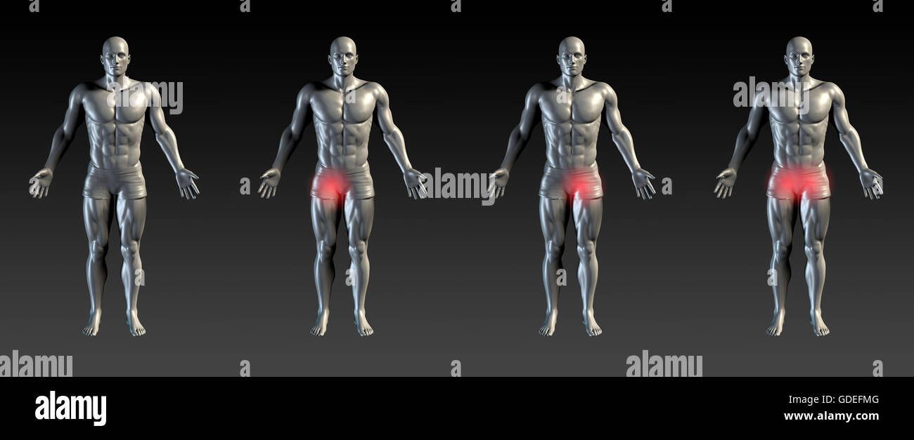 Lesiones de la ingle con resplandor rojo en serie de área Fotografía de