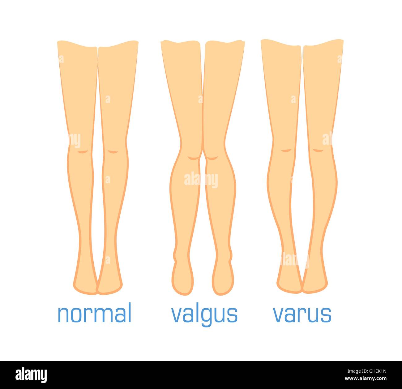 Valgus varo y normal Imagen Vector de stock Alamy