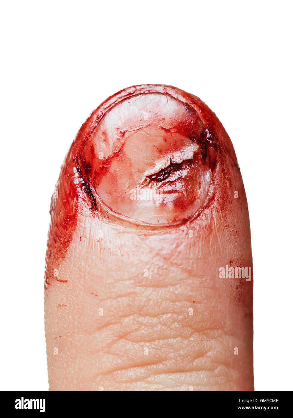 Herida de sangre la uña del dedo Foto de stock