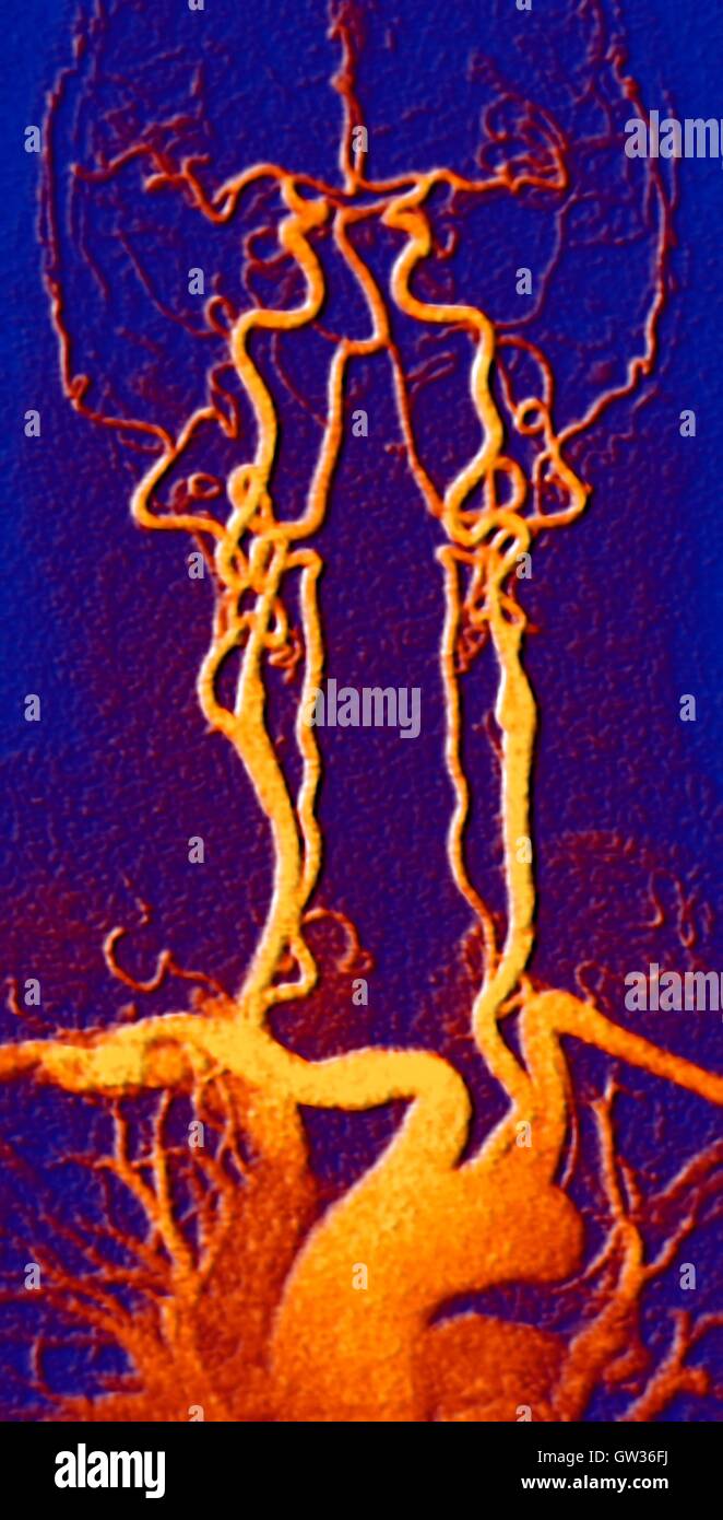 El pecho, el cuello y la cabeza de las arterias. Color angiografía por resonancia magnética (ARM) exploración de un sistema carotídeo normal de un hombre de 55 años de edad. Abajo en el centro es el arco de la aorta, la cual se curva sobre el corazón. Las arterias que se ramifican desde estas son: el brachiocepha Foto de stock