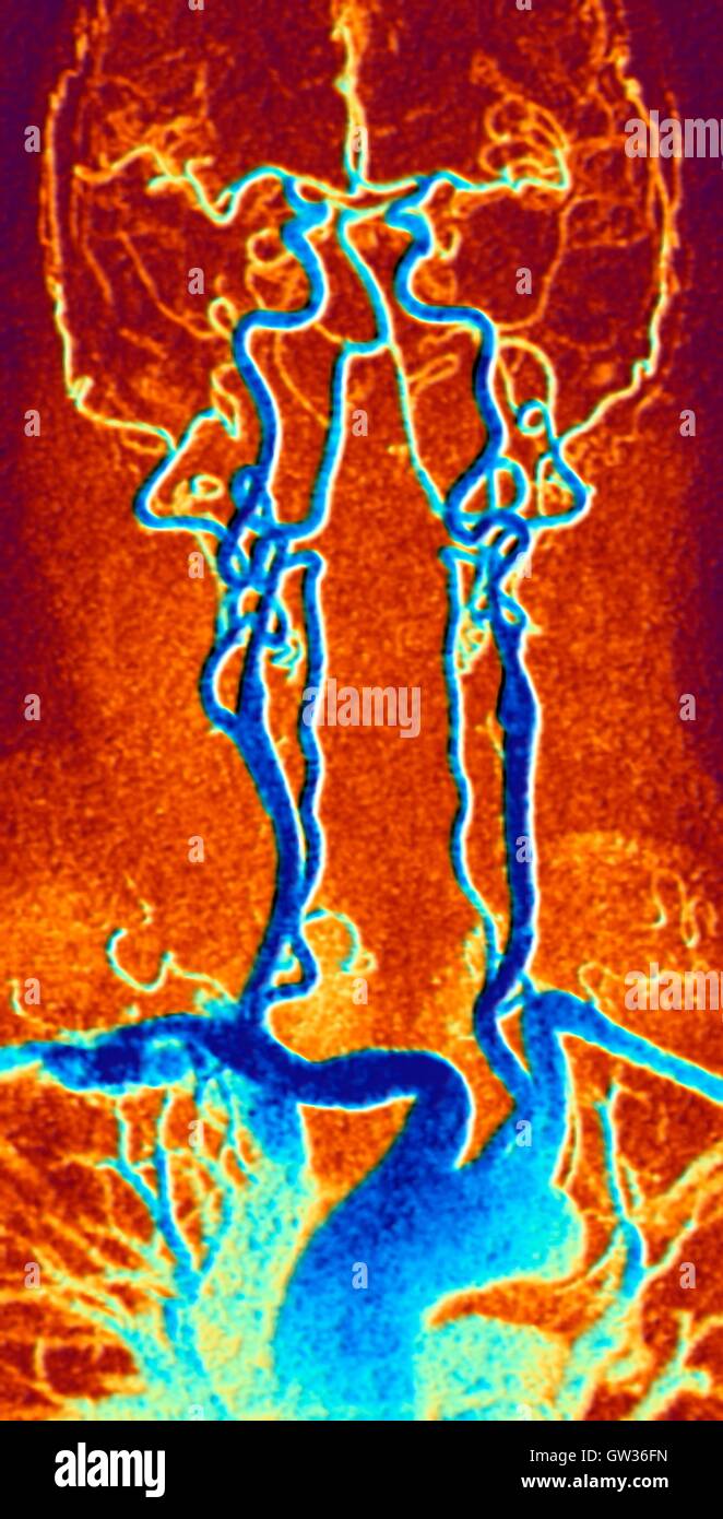 El pecho, el cuello y la cabeza de las arterias. Color angiografía por resonancia magnética (ARM) exploración de un sistema carotídeo normal de un hombre de 55 años de edad. Abajo en el centro es el arco de la aorta, la cual se curva sobre el corazón. Las arterias que se ramifican desde estas son: el brachiocepha Foto de stock