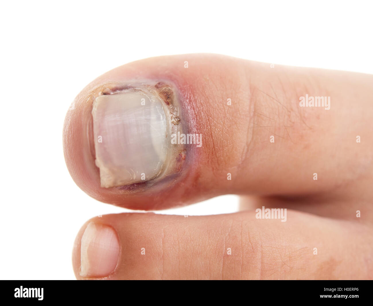 Roto el dedo gordo con uña desapego sobre fondo blanco puro Foto de stock