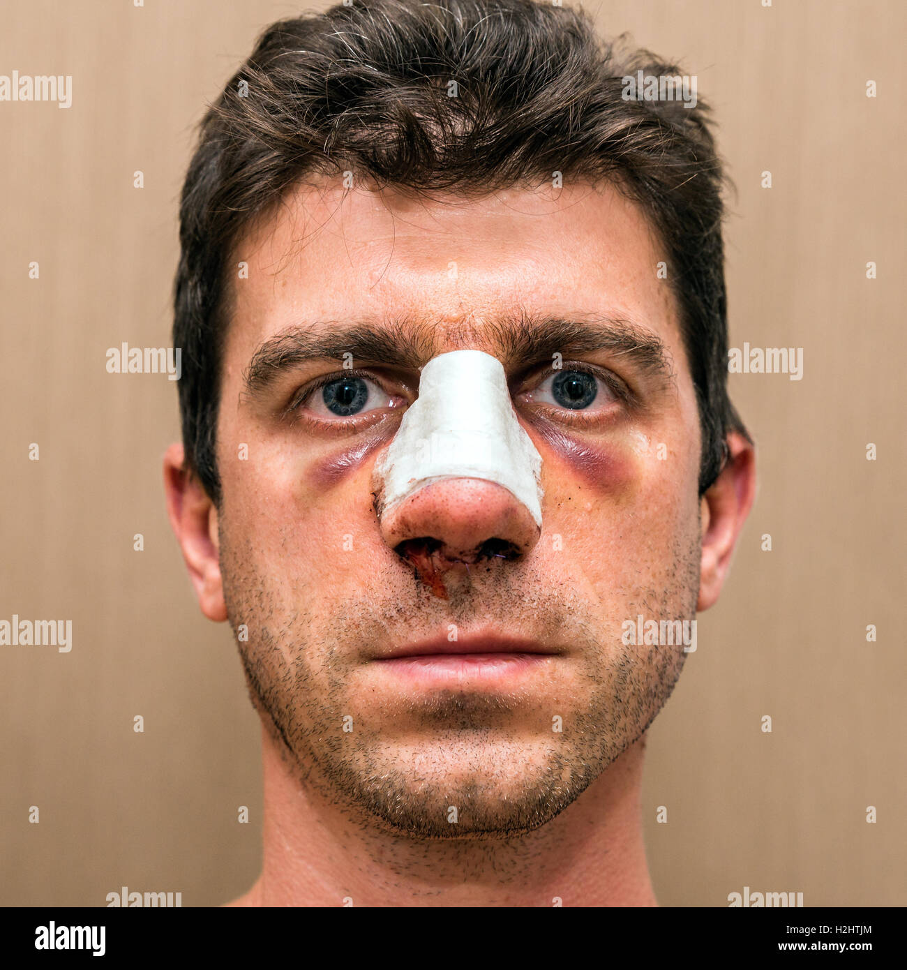 El hombre la recuperación después de una cirugía de rinoplastia