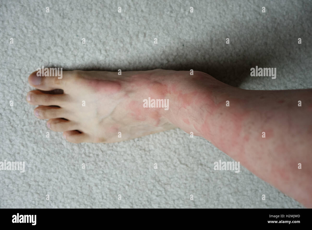 Reacción de la piel enrojecimiento de la colmena pierna pie Foto de stock