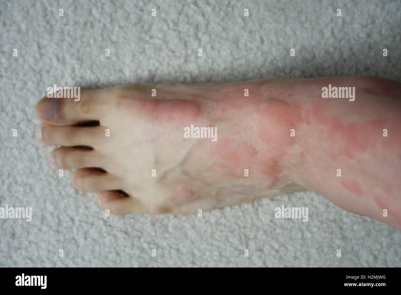 Reacción alérgica severa de la piel del pie de la colmena Foto de stock