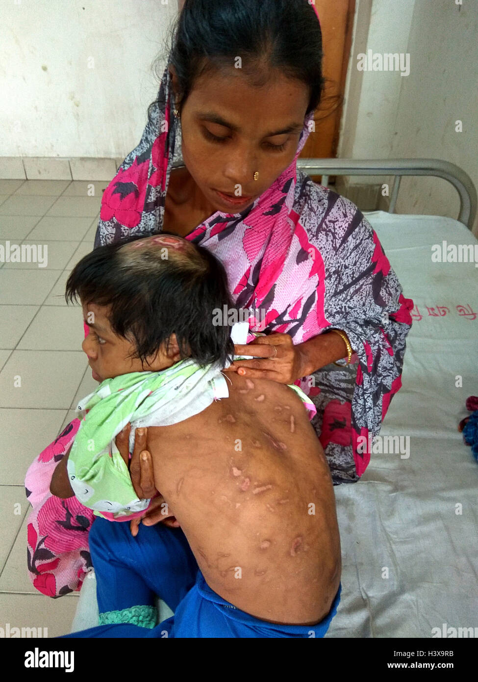 Dhaka, 02 de octubre de 2016. Una mujer mostrando las en el cuerpo de su hija de siete años, Jannat, en la unidad de quemados del Hospital Universitario de Dhaka recientemente.