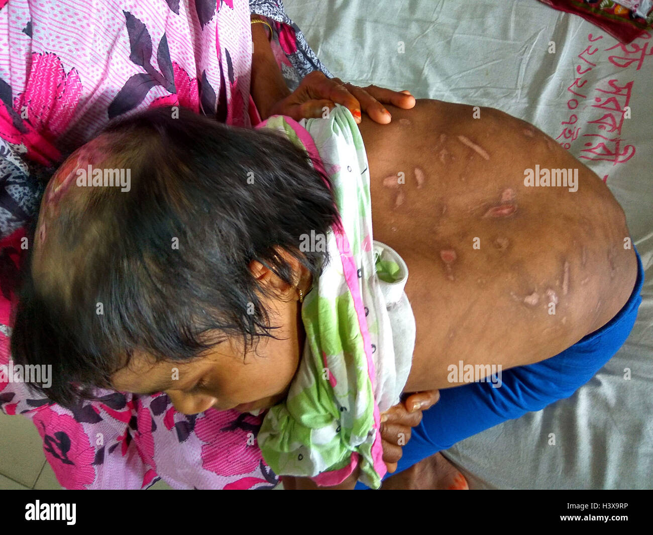 Dhaka, 02 de octubre de 2016. Una mujer mostrando las cicatrices en el  cuerpo de su hija de siete años, Jannat, en la unidad de quemados del  Hospital Universitario de Dhaka recientemente.