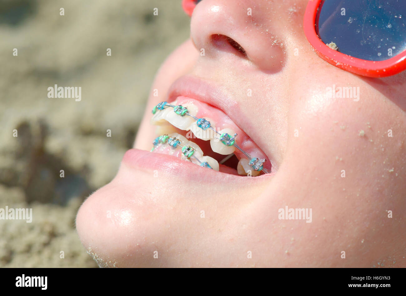 Mujer joven con soportes en los dientes, primer plano Foto de stock