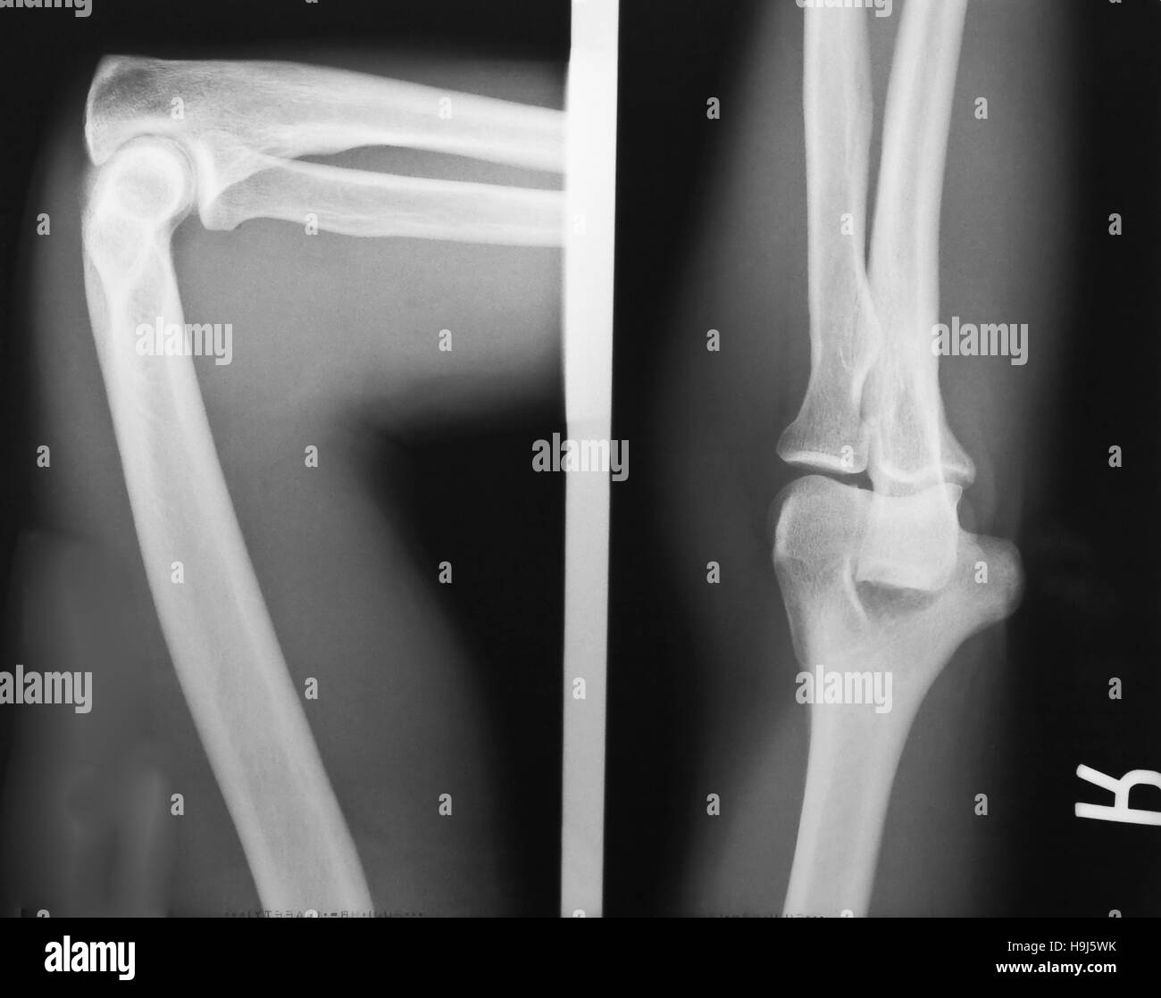 Radiografía De Anatomía Del Codo