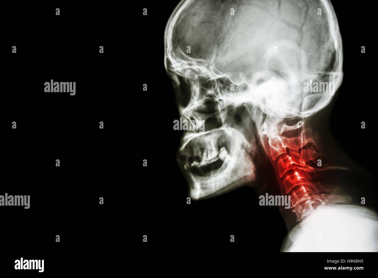 Espondilosis cervical . película X-ray vista lateral de cráneo y cuello dolor . Foto de stock
