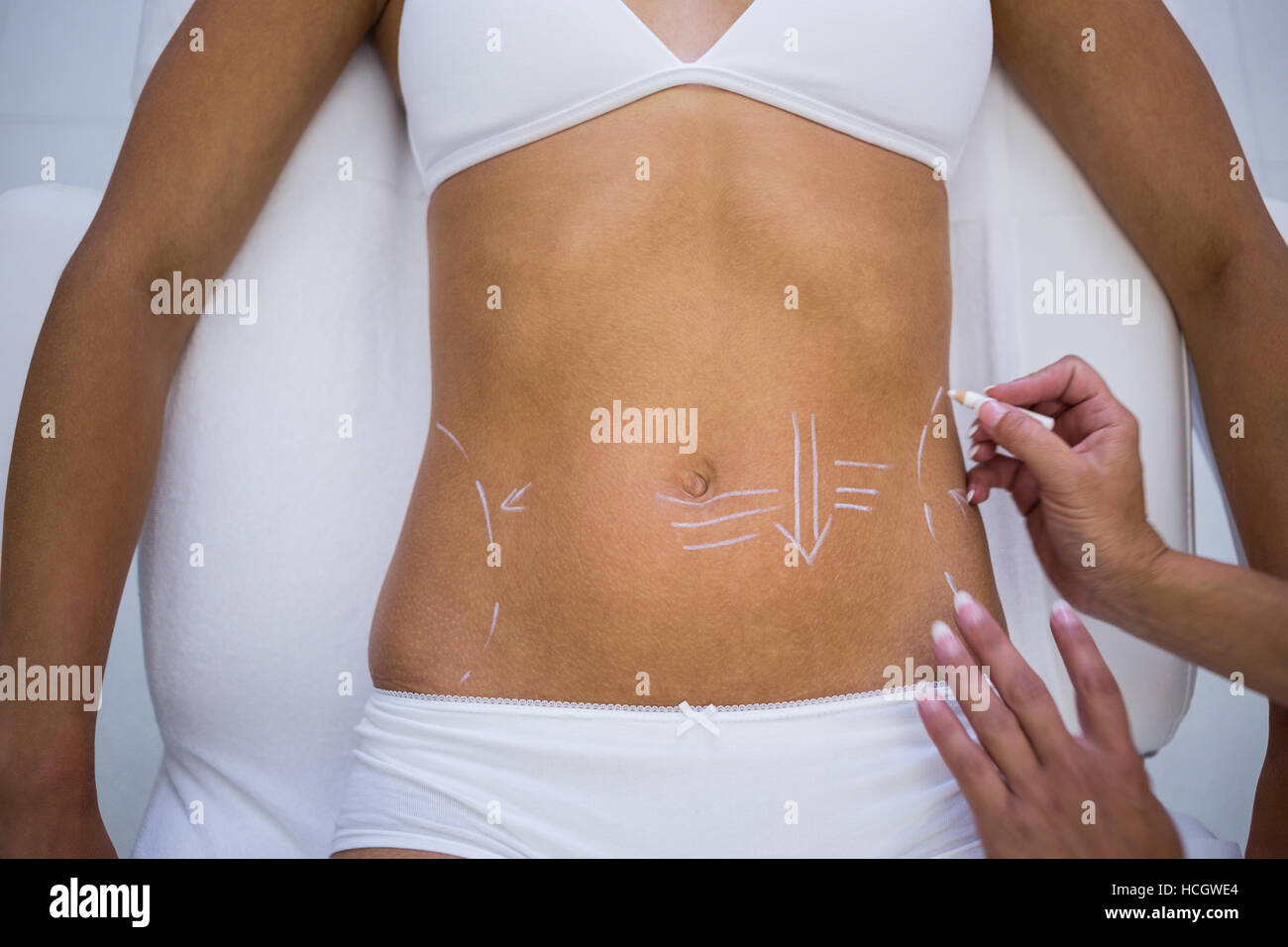 Cirujano dibujar líneas sobre womans para liposucción de abdomen y celulitis extracción Foto de stock