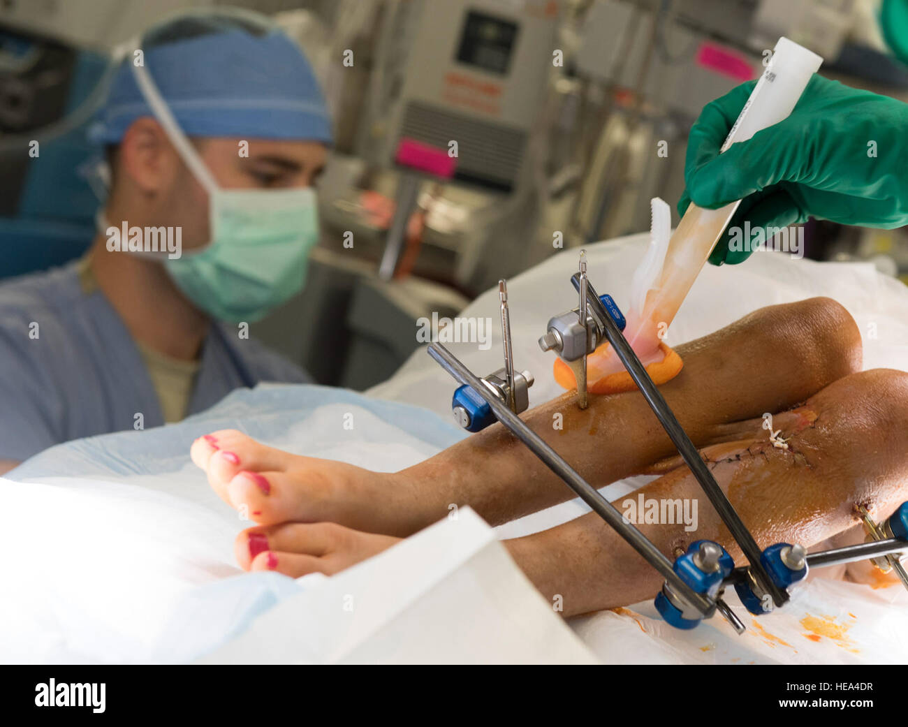 Gral. David Vizurraga, Expedicionaria 455a Grupo Médico cirujano ortopédico, esteriliza las piernas de un paciente afgano como teniente coronel Edward López, 455EMDG anestesiólogo vigila sus signos vitales durante la cirugía, 10 de junio de 2016 en el Teatro Craig-Joint Hospital, aeródromo de Bagram, Afganistán. La paciente ha sido sometida a múltiples cirugías para ayudar a reparar la pierna después de ser disparado. Tech. El Sgt. Tayronas Lawson) Foto de stock