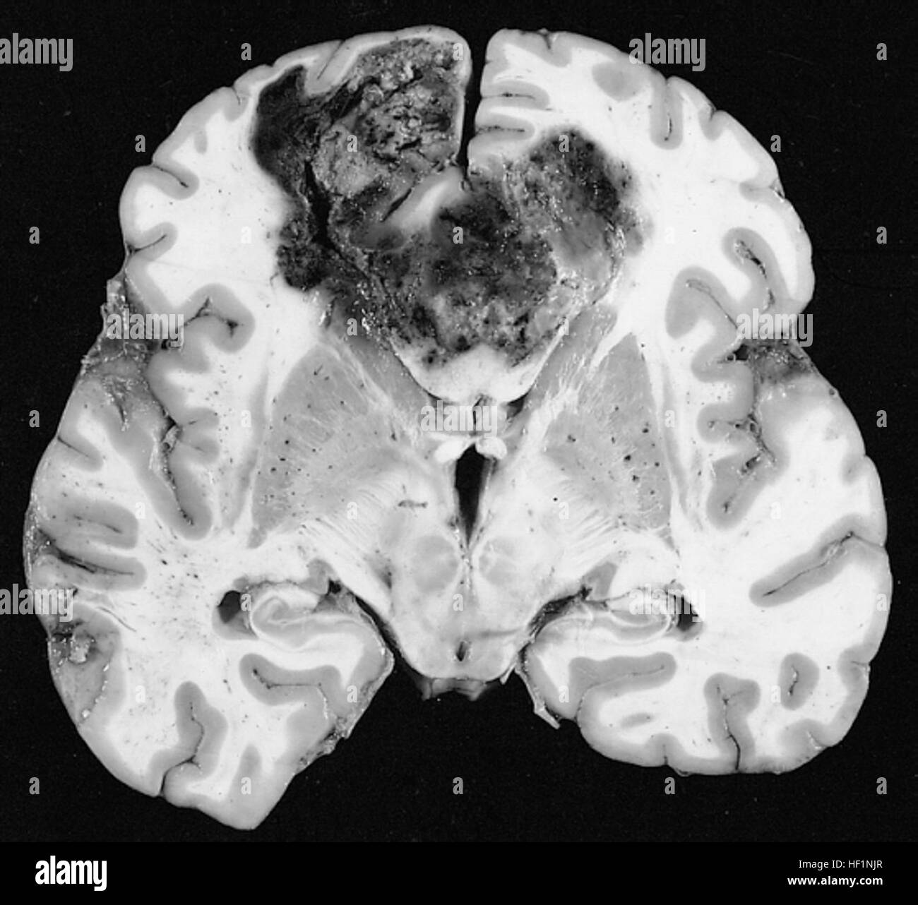 Glioblastoma multiforme fotografías e imágenes de alta resolución Alamy