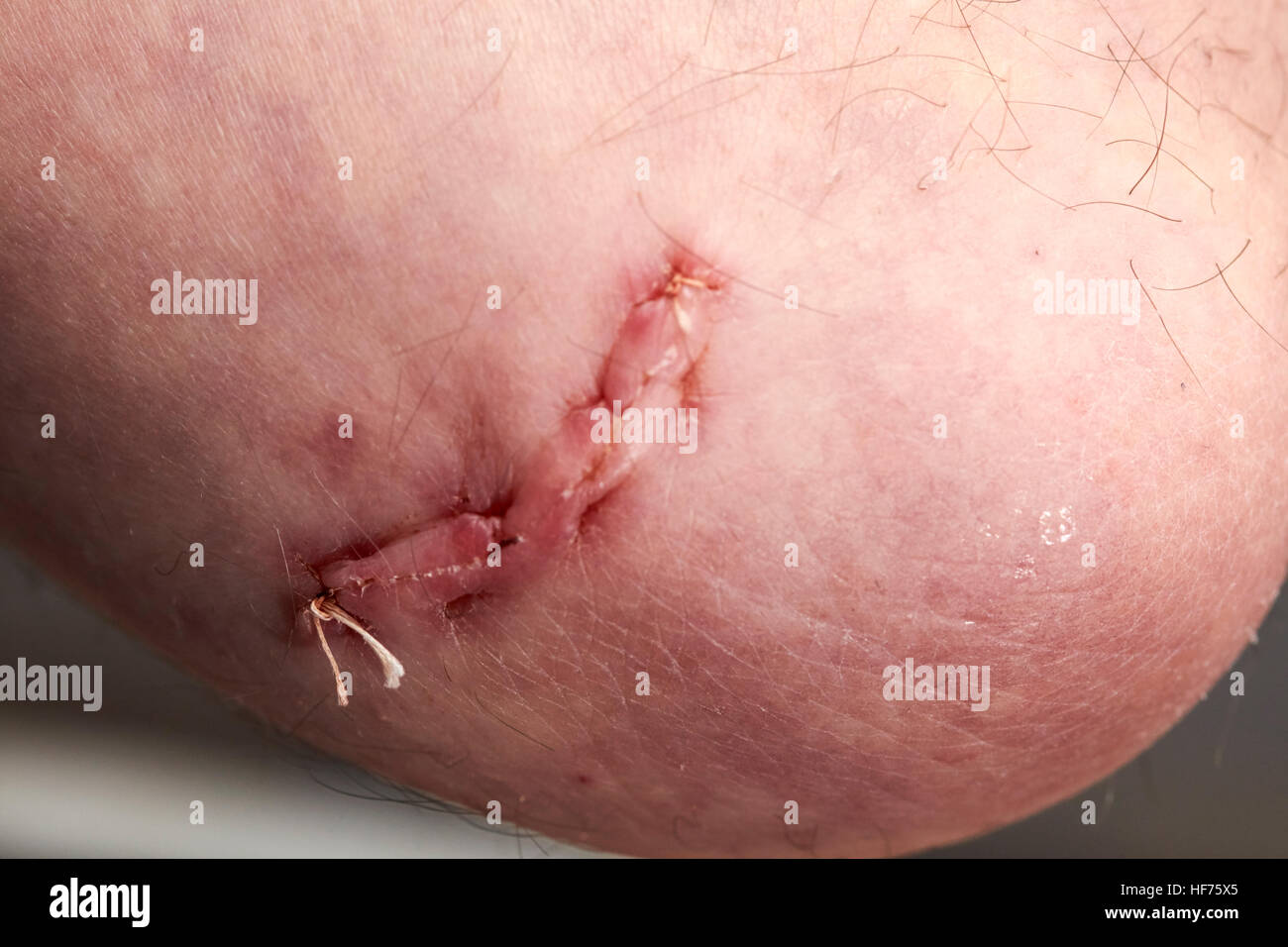 Suturas Absorbibles en el codo de la herida quirúrgica para corregir el síndrome del túnel cubital Foto de stock