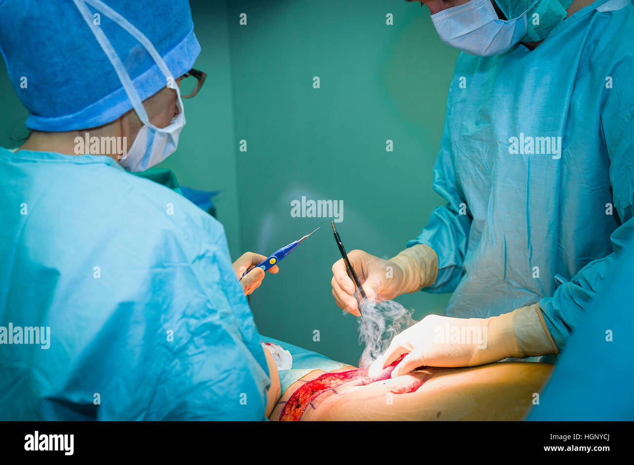 Abdominoplasty surgery fotografías e imágenes de alta resolución - Alamy