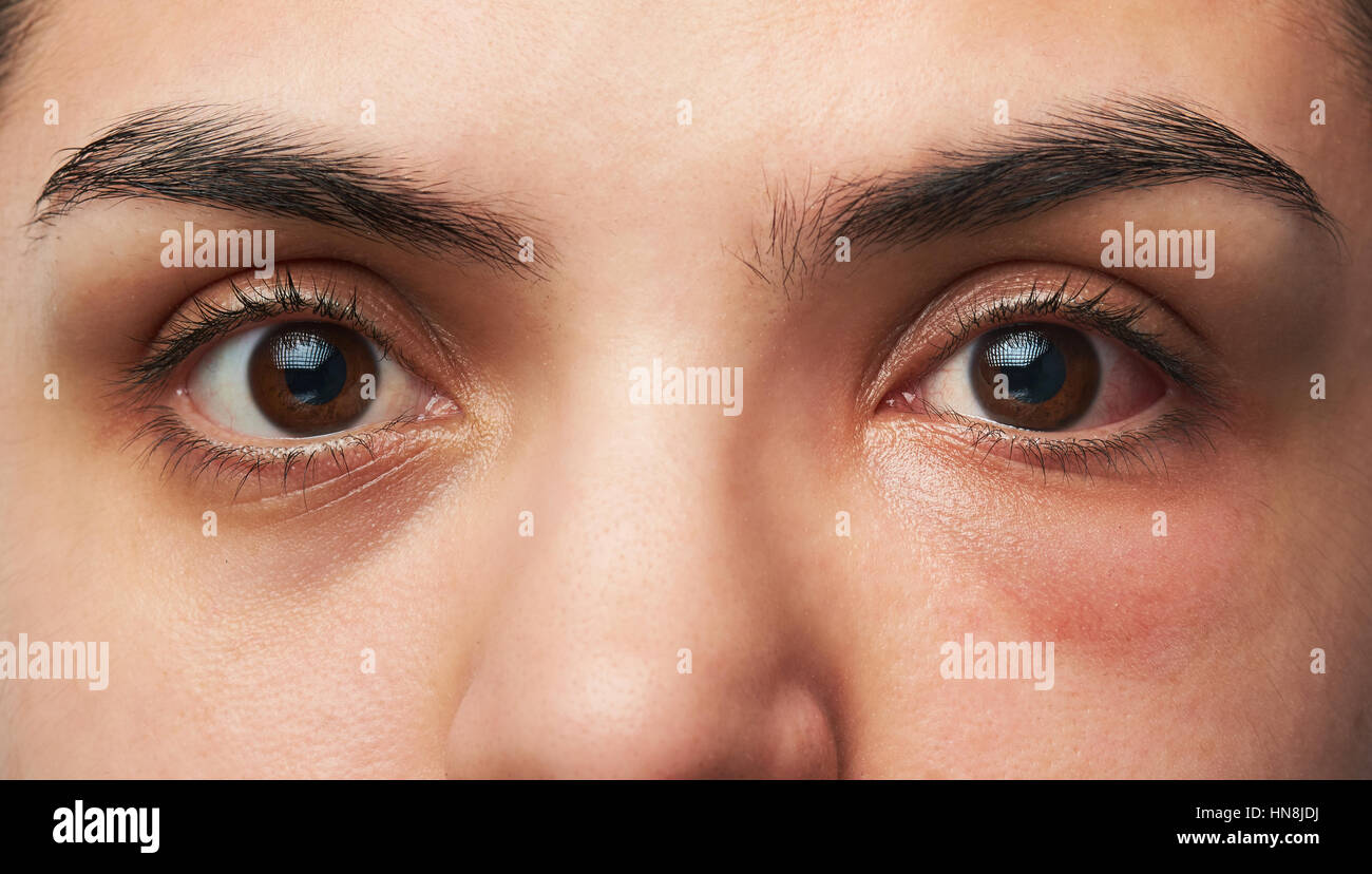 Cerca de dos ojos de mujer con la reacción alérgica en un ojo rojo Foto de stock