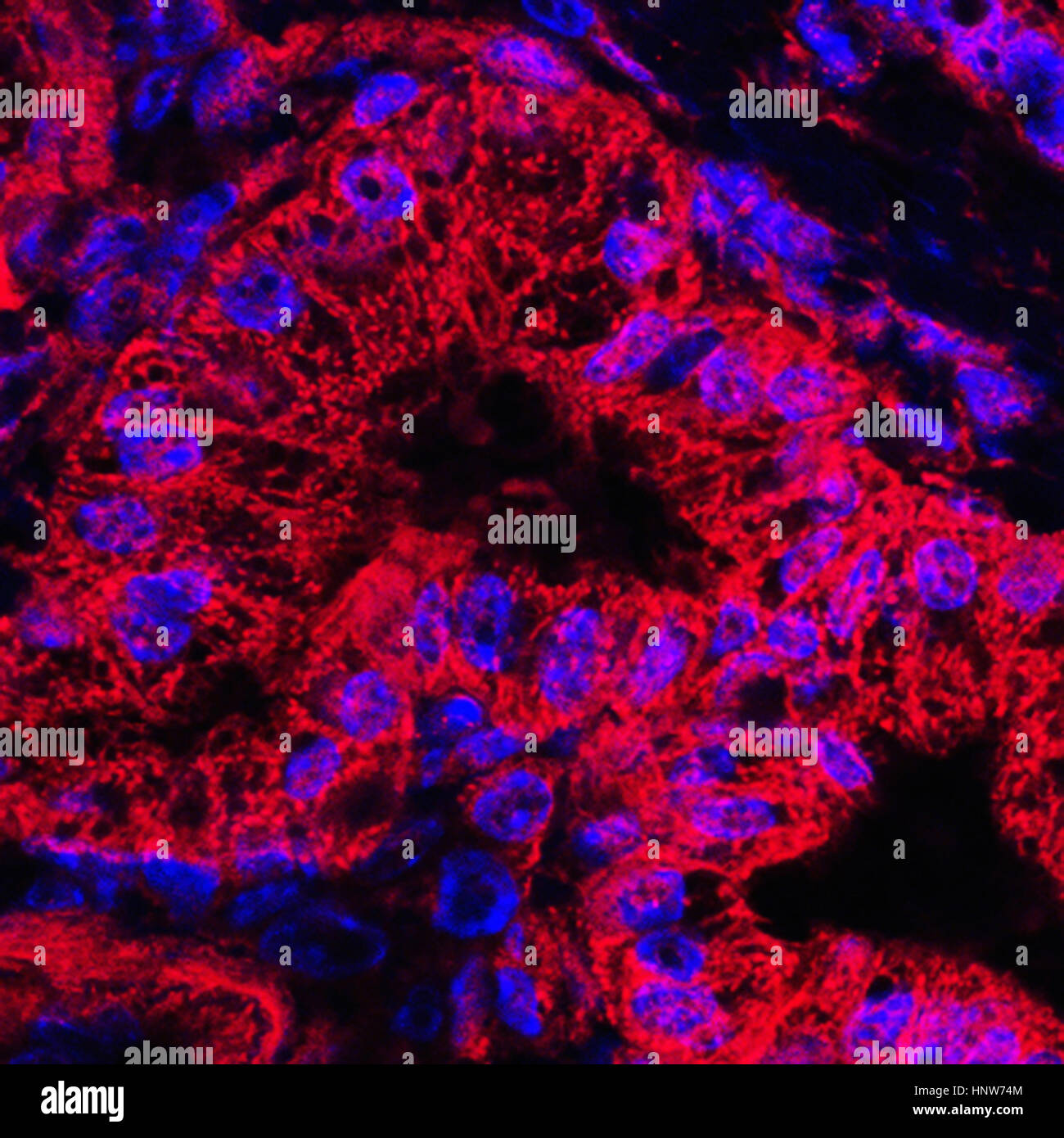 Imagen microscópica de las células del cáncer pancreático manchada mitocondrial Foto de stock