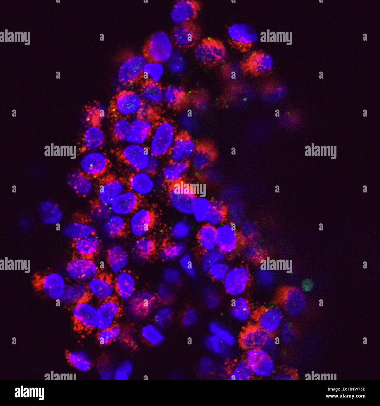 Imagen microscópica de células de cáncer del seno circulantes cluster Foto de stock