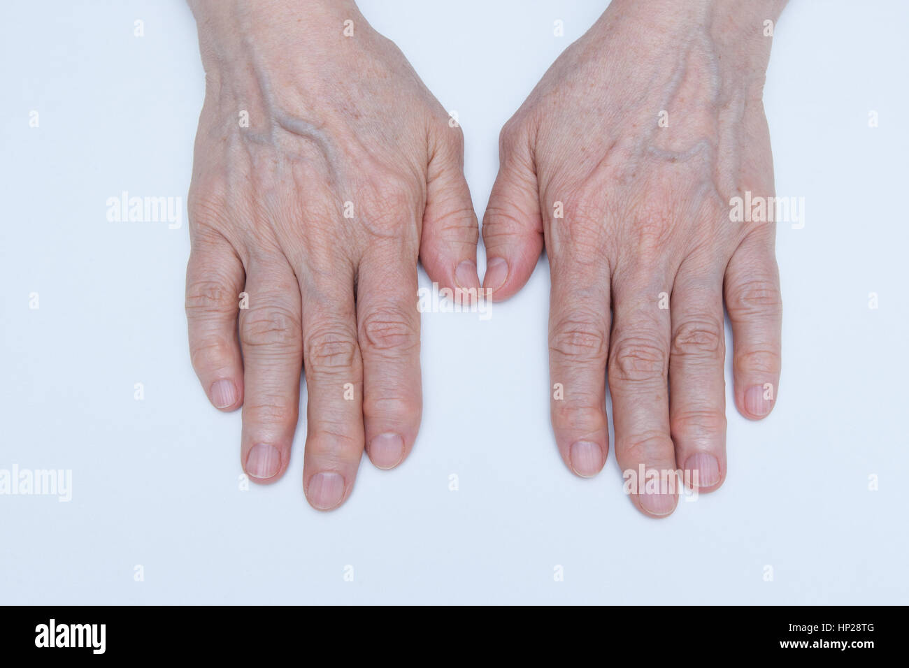 La Artrosis de manos y dedos de una mujer Fotografía de stock - Alamy