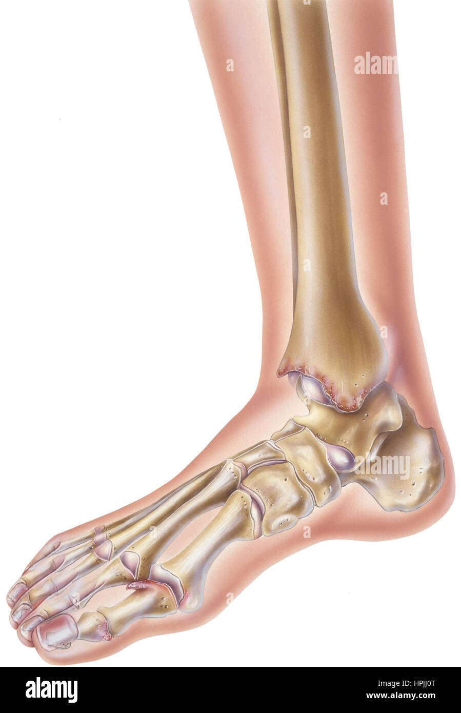 En el caso de la artritis reumatoide del pie y del tobillo, el sinovio