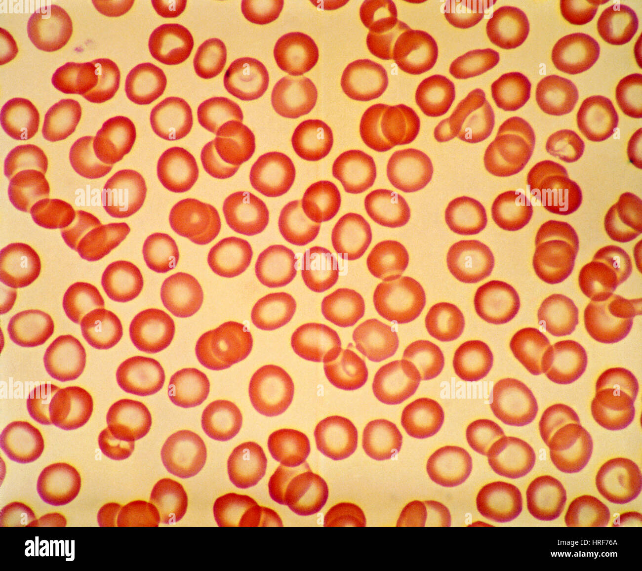 Deficiencia de hierro los glóbulos rojos Fotografía de stock - Alamy