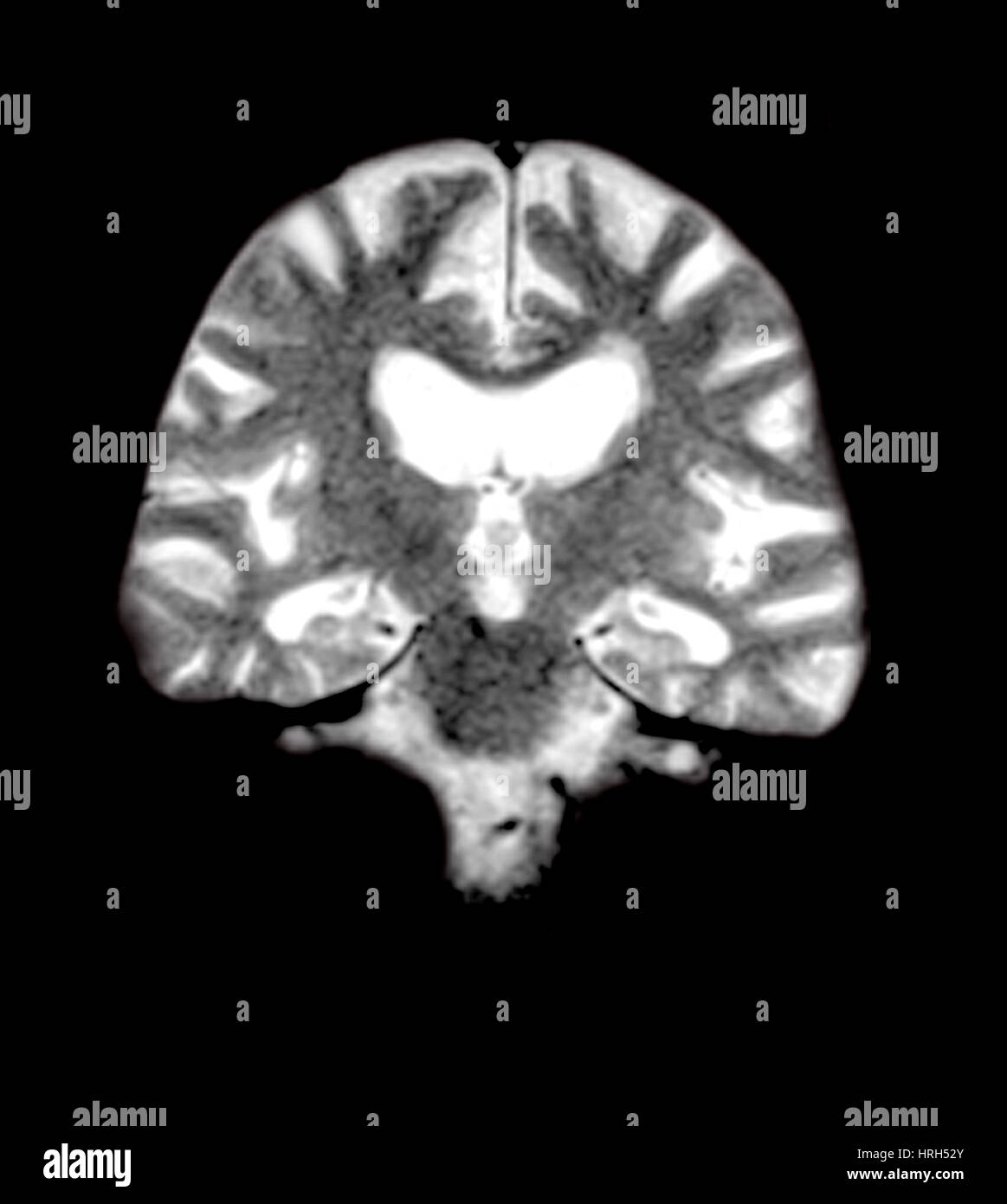 Irm del cerebro con la enfermedad de Alzheimer Foto de stock