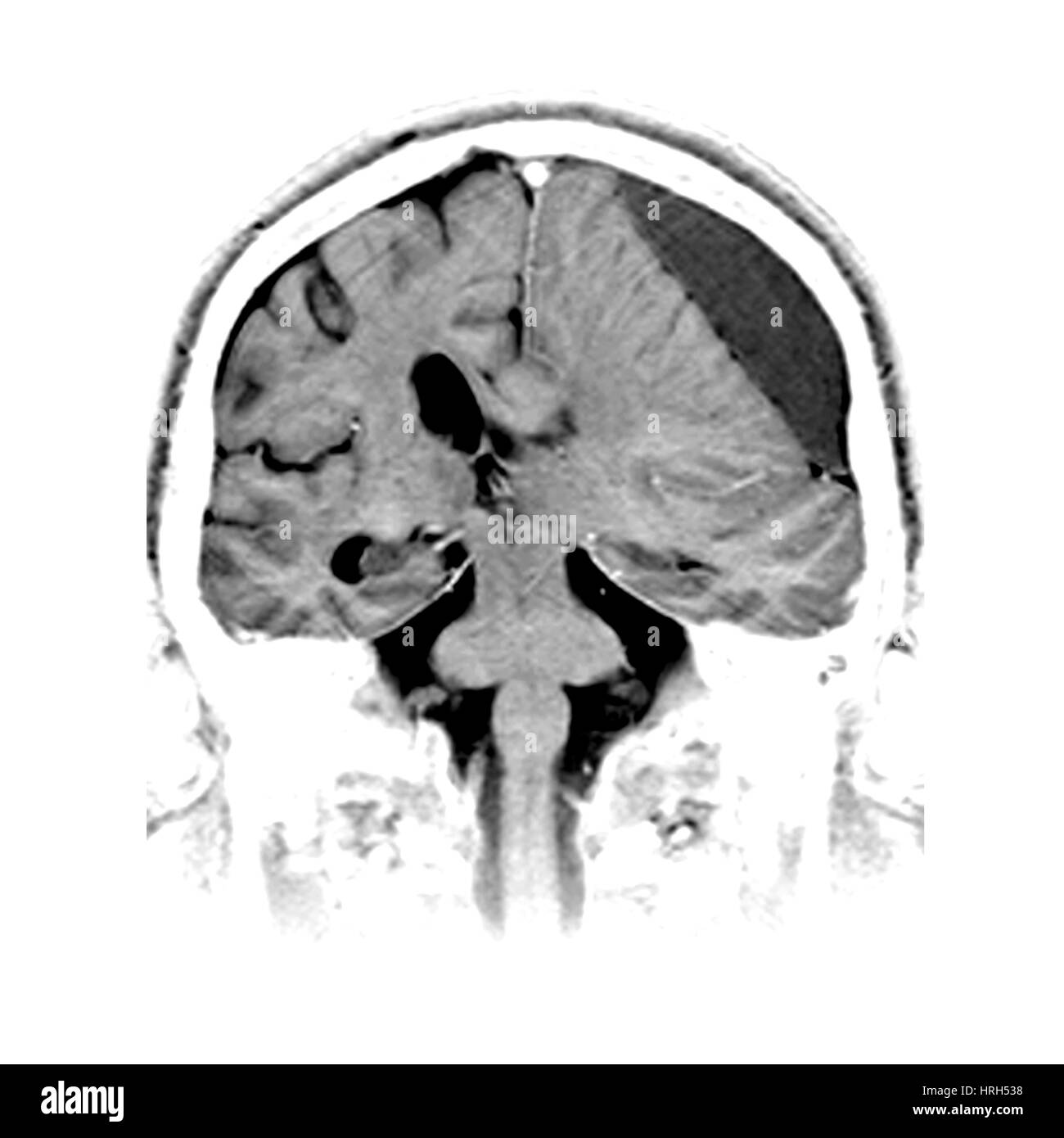 Hematoma subdural Foto de stock